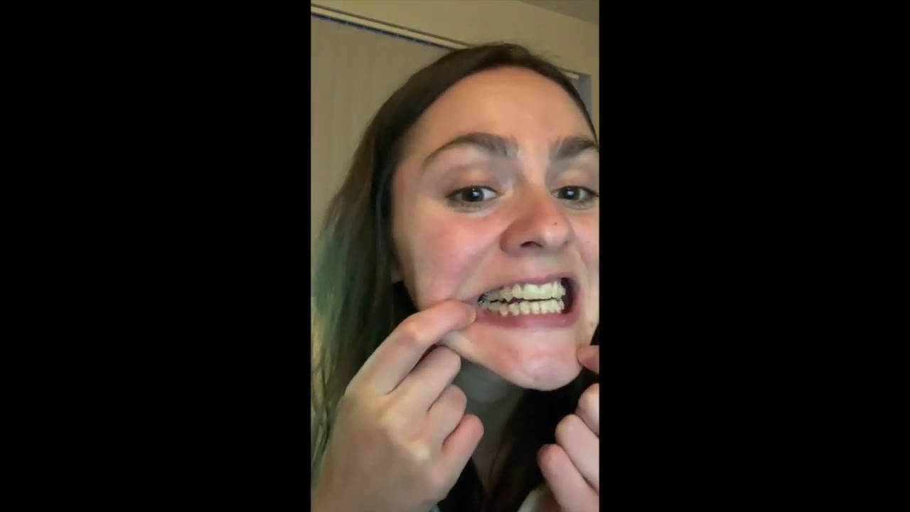 CFast Braces - My experience (Week 2)