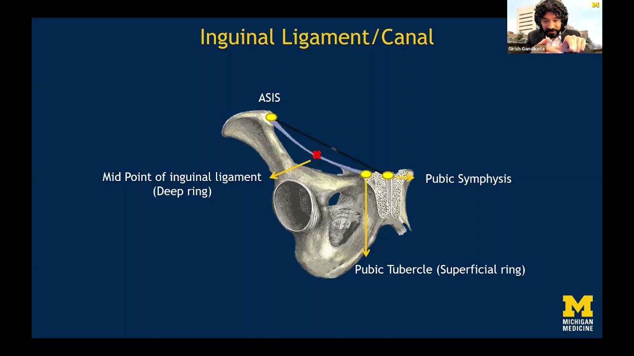 Ultrasound Diagnosis of Subtle Groin Hernia