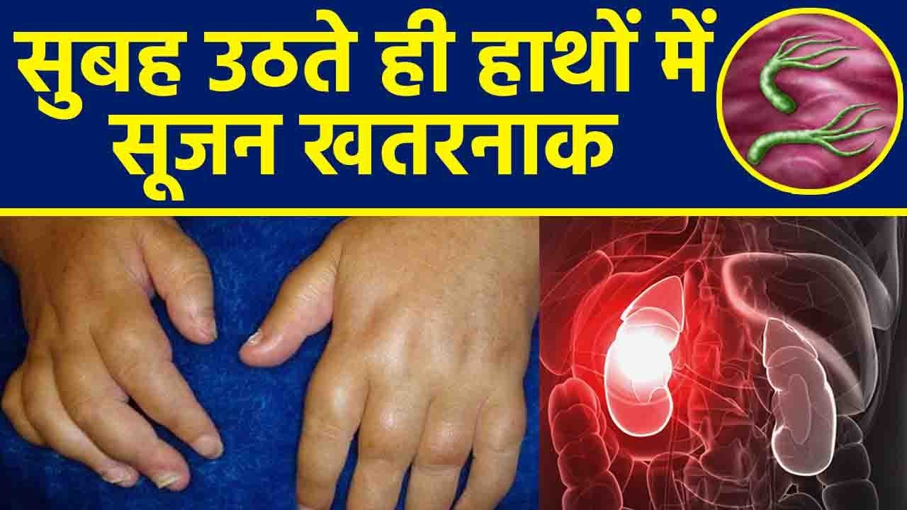 सुबह उठते ही हाथों में सूजन खतरनाक | सुबह उठते ही हाथों में सूजन क्यों होती है |Boldsky *Health
