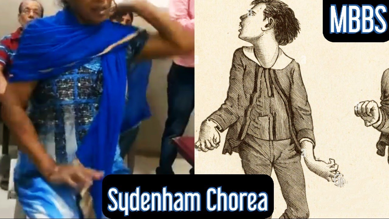 Sydenham Chorea or St Vitus Dance- Basal Ganglia Disorder #mbbs #medicine #neet #next #usmle