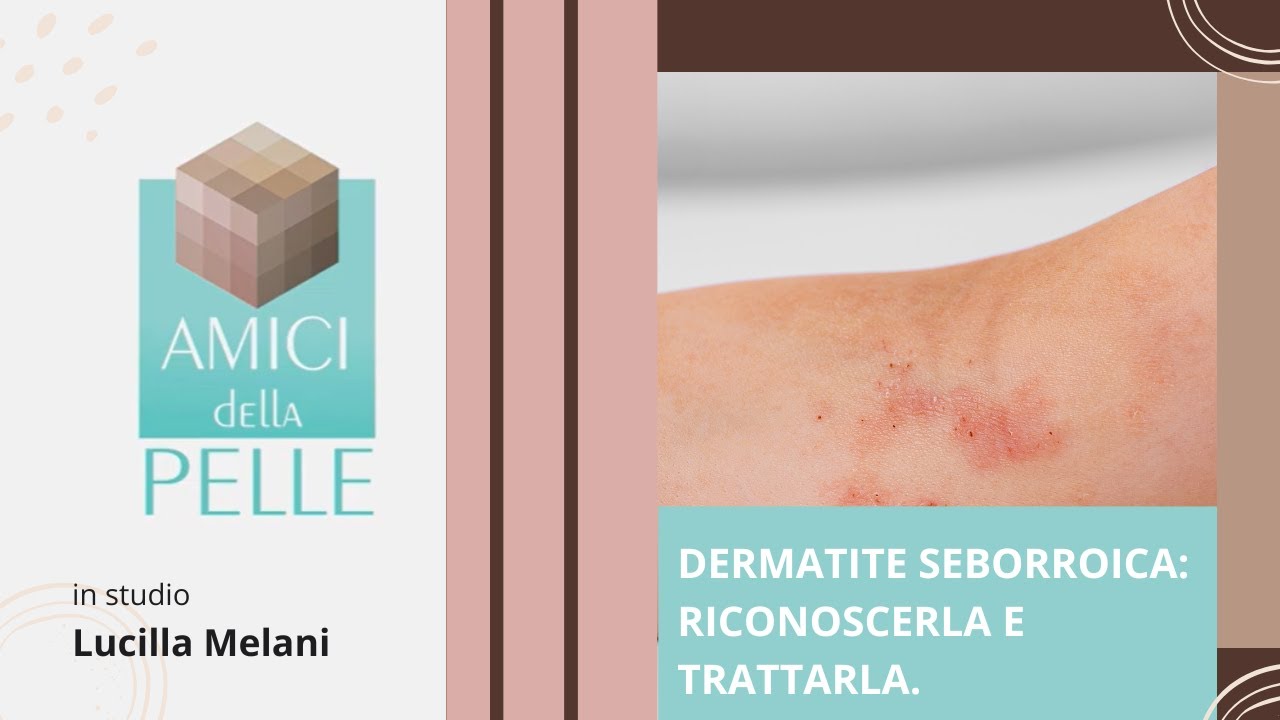 Dermatite seborroica: riconoscerla e trattarla.