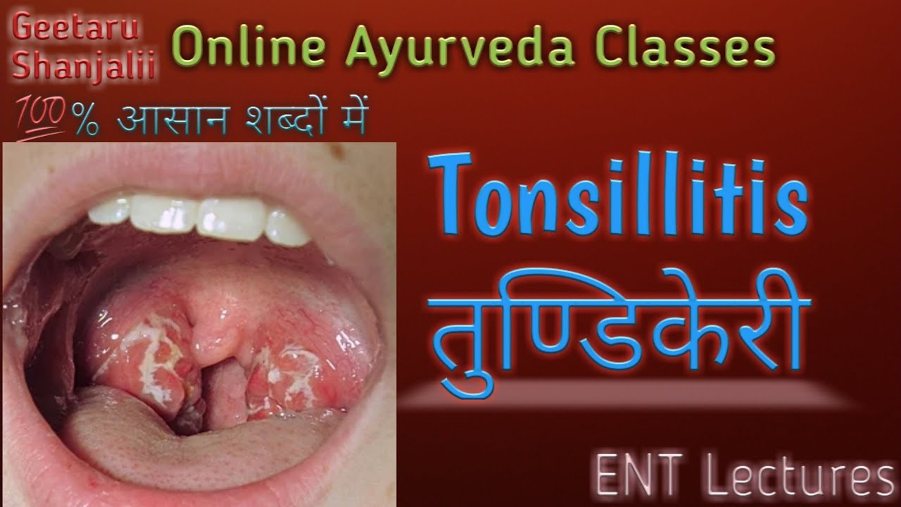 Tonsillitis or तुण्डिकेरी