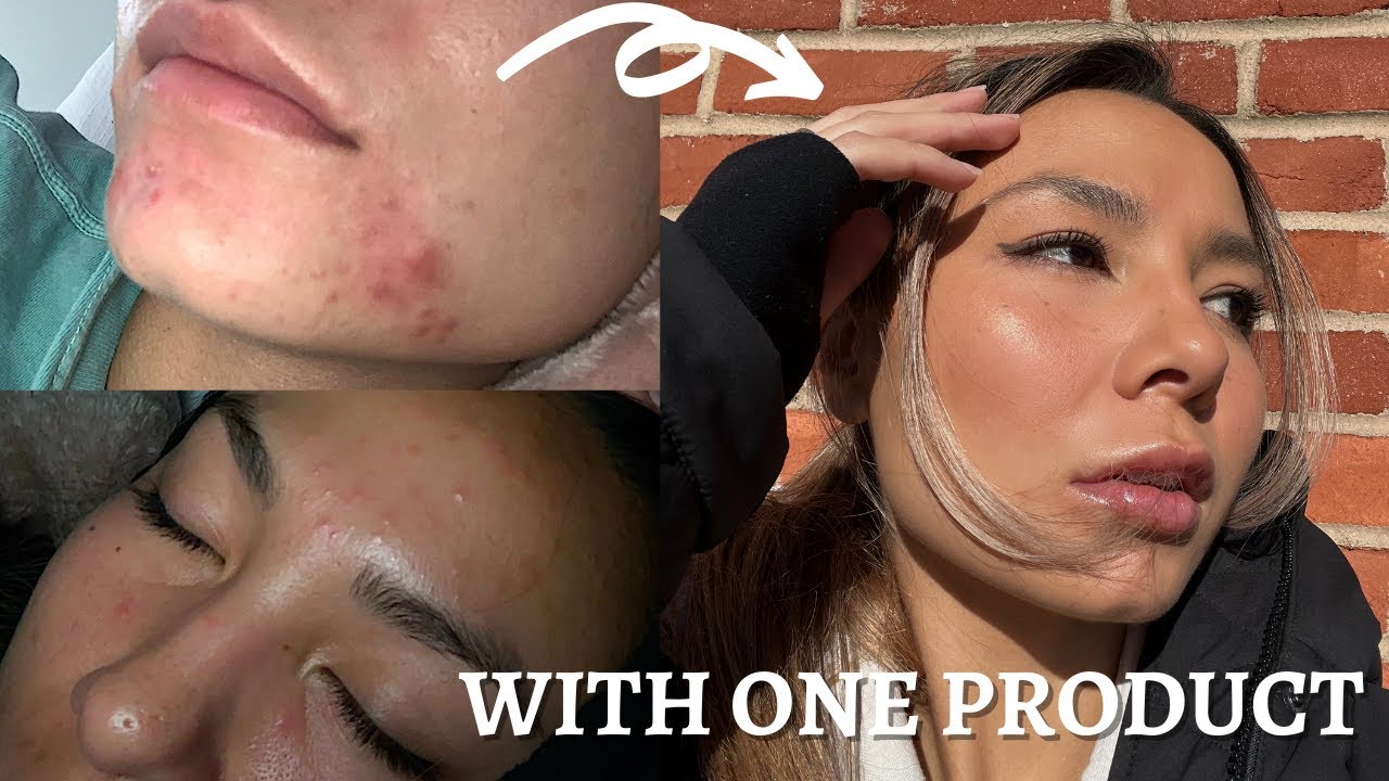 HOW I CLEARED MY SKIN WITH ONE PRODUCT FAST: Panoxyl, hormonal acne, cystic acne
