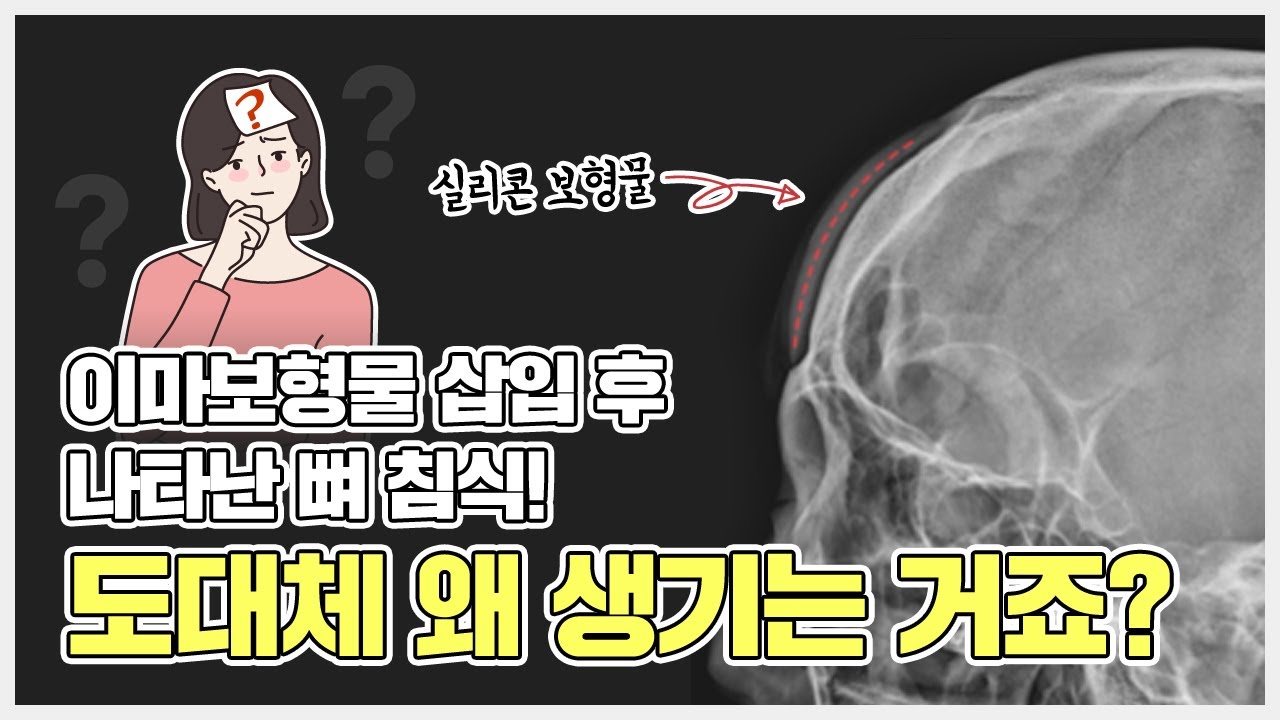#이마보형물 때문에 뼈가 침식되는 이유!! 보형물 절.대 넣지 마세요 ❌