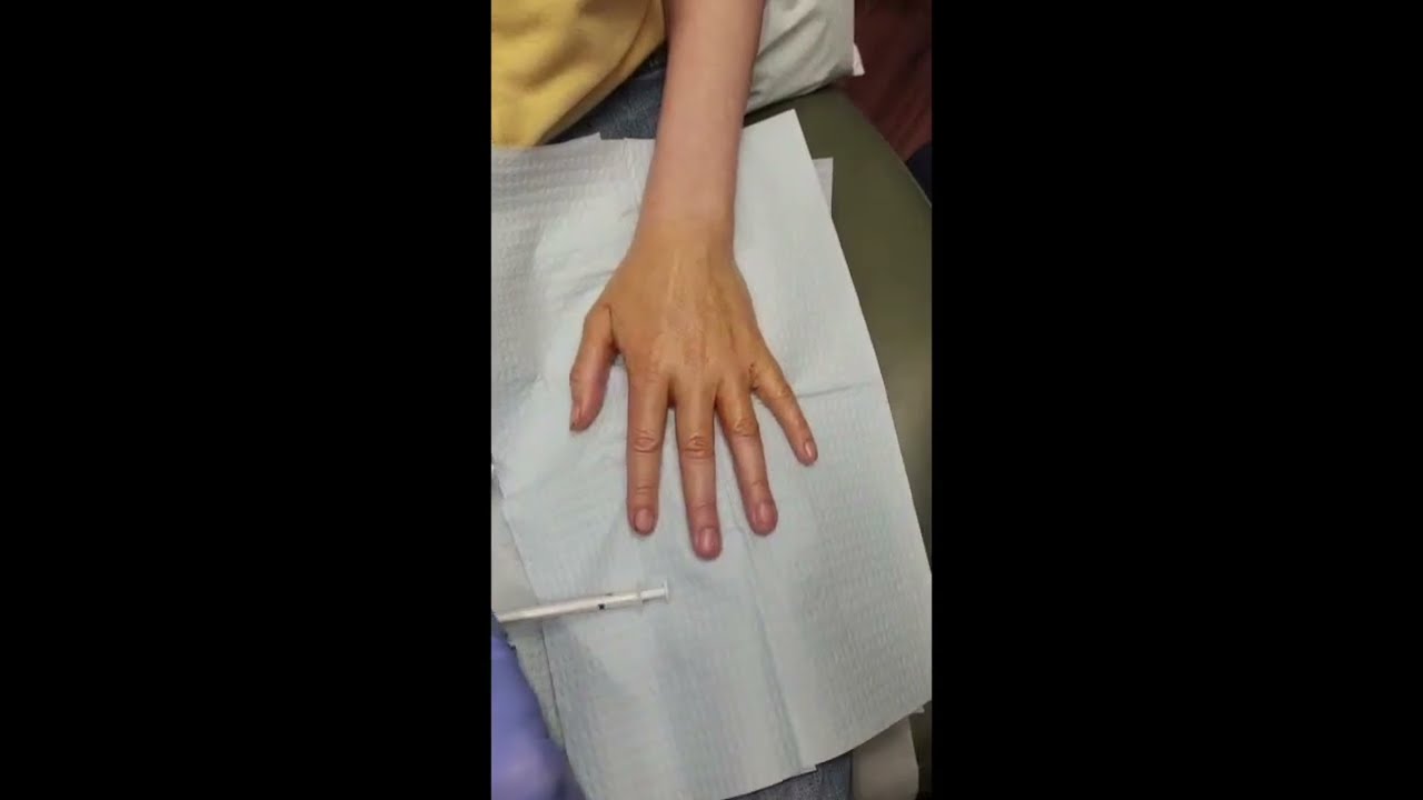 Dr. Dean Kane Injects Sculptra for the Hands