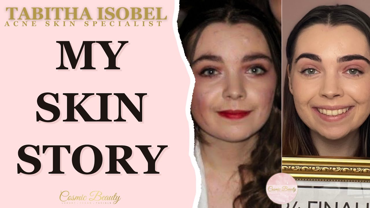 My Acne Skin Story | Skin Specialist