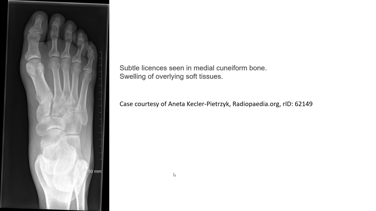 Medial Cuneiform Fracture Imaging