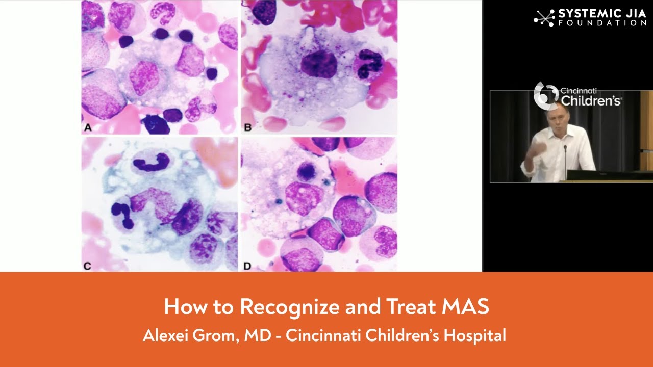 How to Recognize and Treat MAS - Dr. Grom