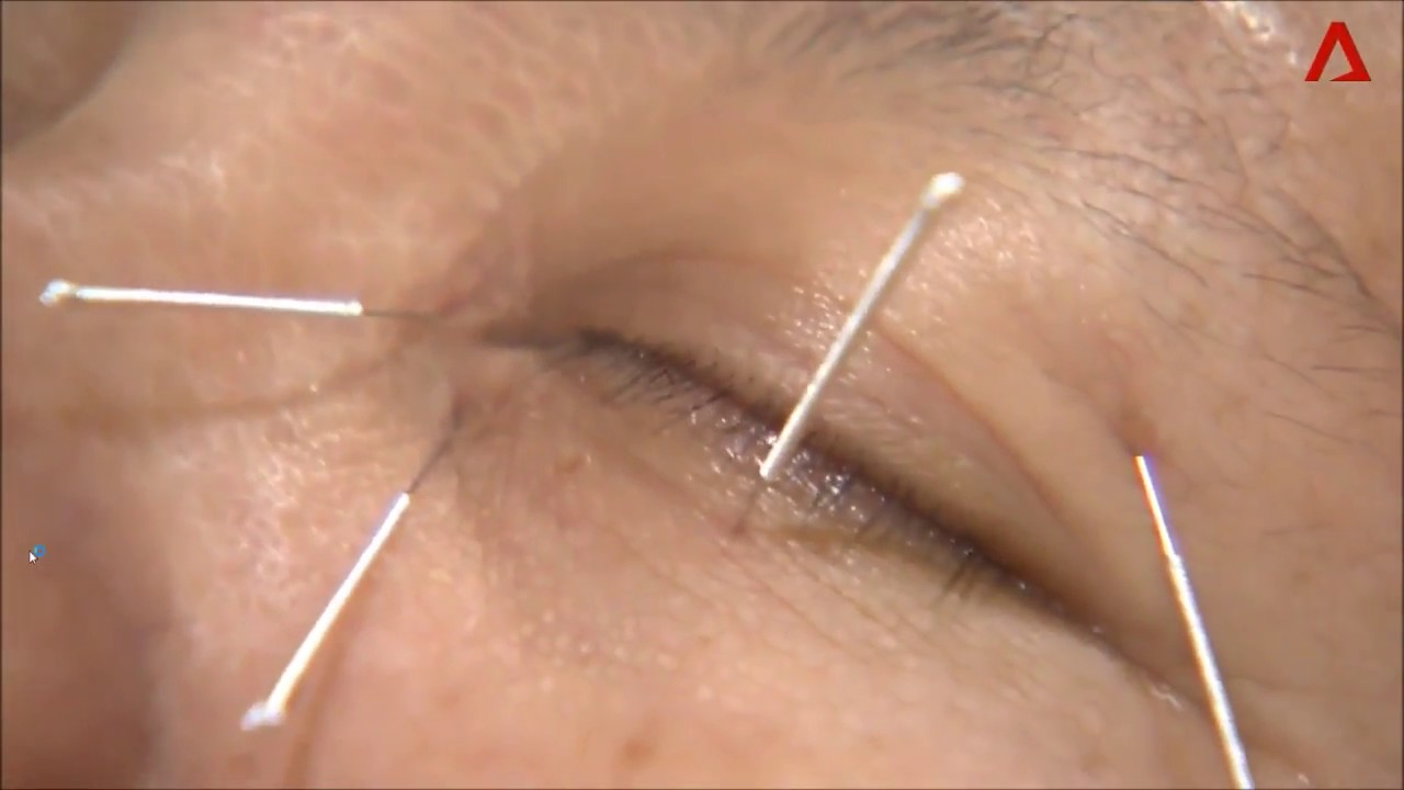 TCM treatment for dry eye in Singapore