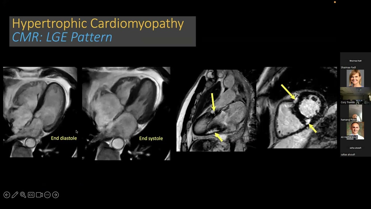 Cardiovascular Magnetic Resonance of Hereditary Cardiomyopathy - Shaimaa Fadl, MD