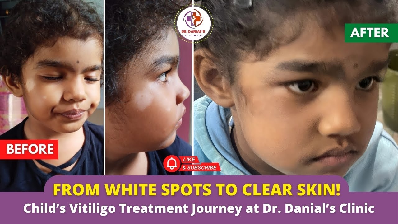 Shocking Vitiligo Recovery in a Kid! | Before & After Results at Dr. Danial&rsquo;s Clinic | #vit&iacute;ligo