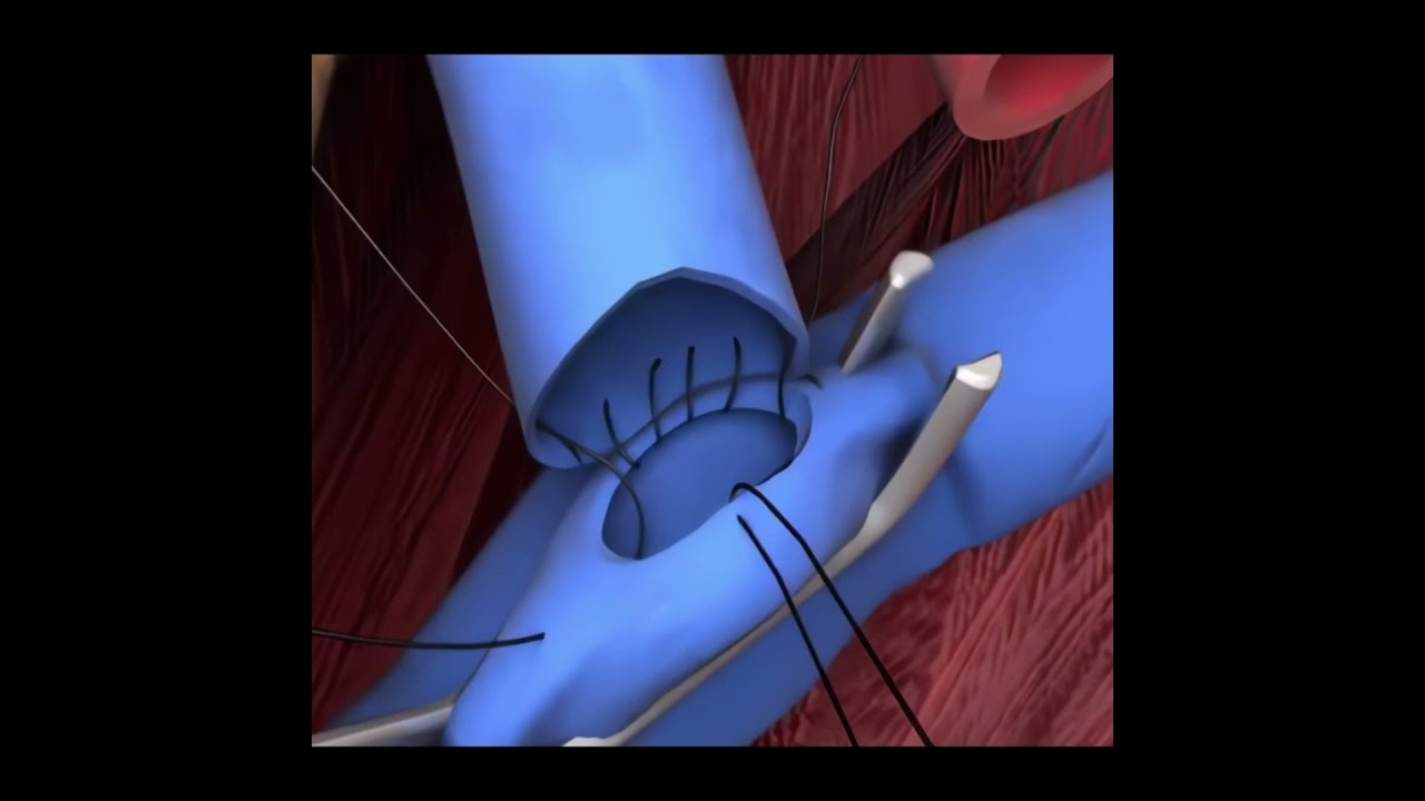 جراحة زرع الكلية | قصور الكلية الكامل