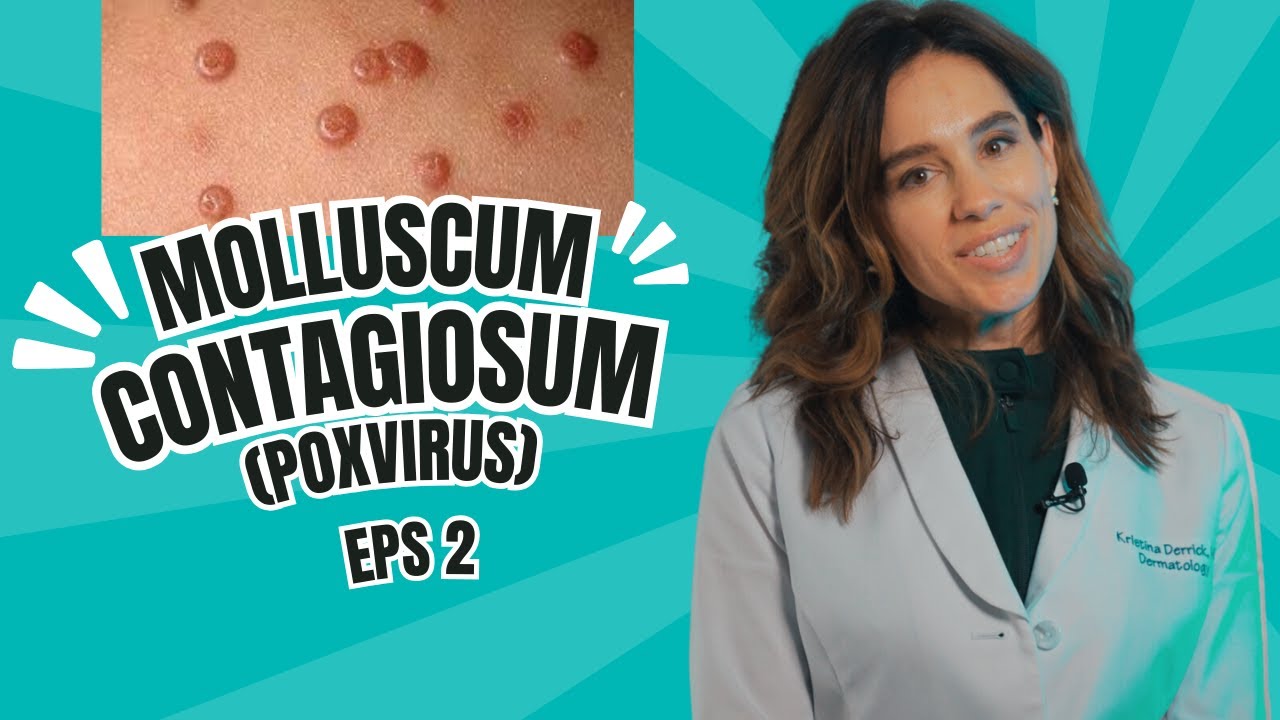 What is Molluscum Contagiosum (Poxvirus) and the treatment for it?