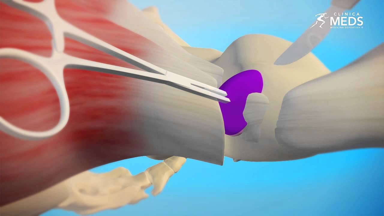 Bursitis de Trocánter y Tendinopatía Glutea Severa
