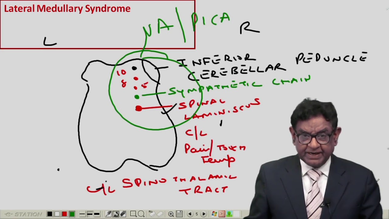 MRCP   | Stroke | Lectures by Dr Bhatia