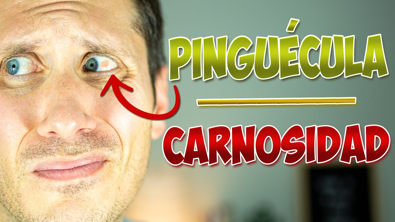 PINGUÉCULA: ¿COMO QUITARLA? 🙈  🩺