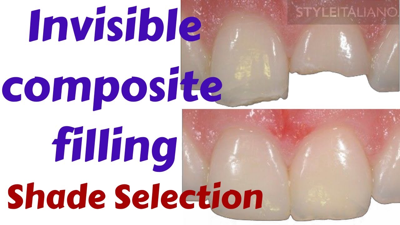 Composite Shade Selection Anterior Central Incisor Composite Filling & Technique - Class IV Fracture