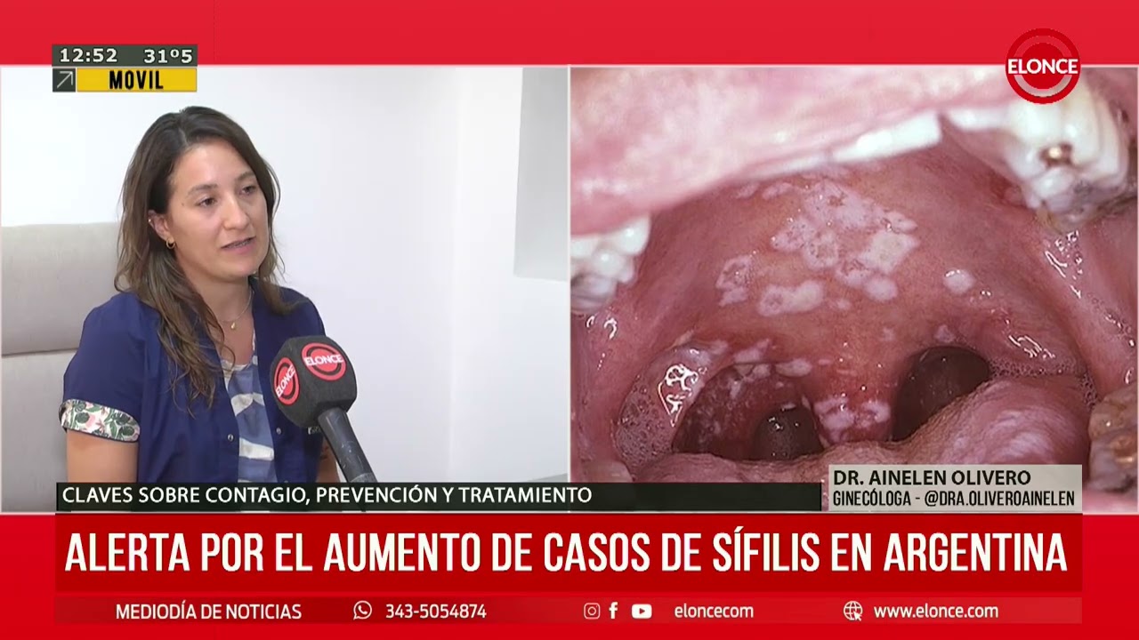 Alerta por el aumento de casos de Sífilis en Argentina - Elonce