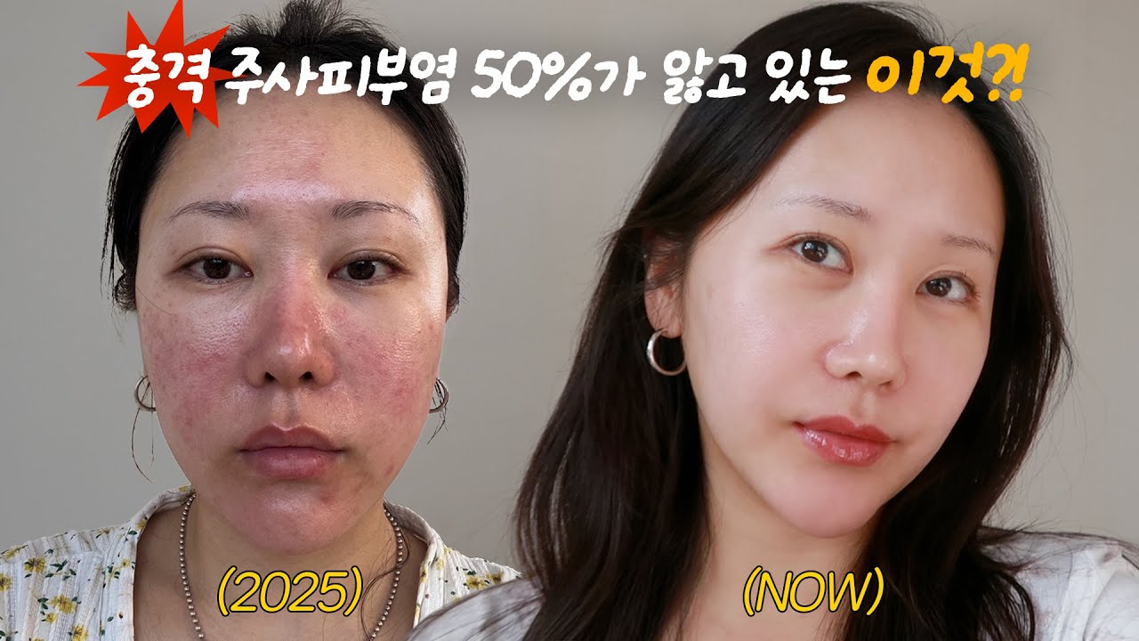 충격주의) 주사피부염이 좋아진 방법; 얼굴 문제가 아니었습니다 (식단, 습관, 스킨케어, 시술 등)