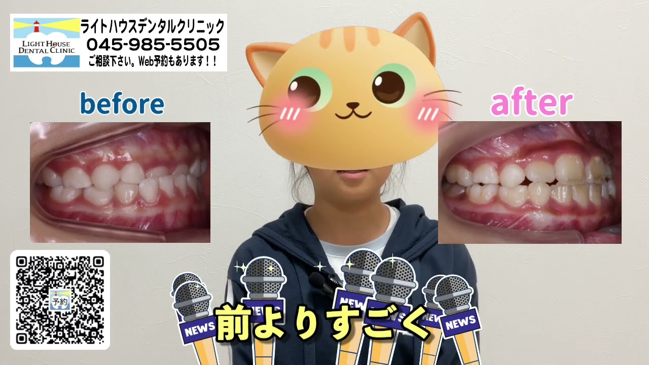 【受け口が治った子に聞いてみた】⭐️ライトハウスDC⭐️ #歯医者 #小児矯正  #小児歯科  #dentist  #ライトハウスデンタルクリニック  #美容  #子育て #矯正 #矯正歯科 #受け口