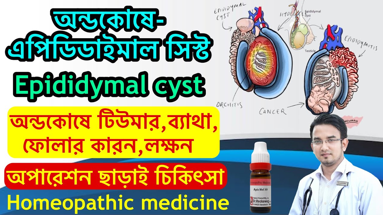 অন্ডকোষে এপিডিডাইমাল সিস্ট এর কারন ও অপারেশন ছাড়াই মুক্তি।Homeopathic medicine for #Epididymal_cyst