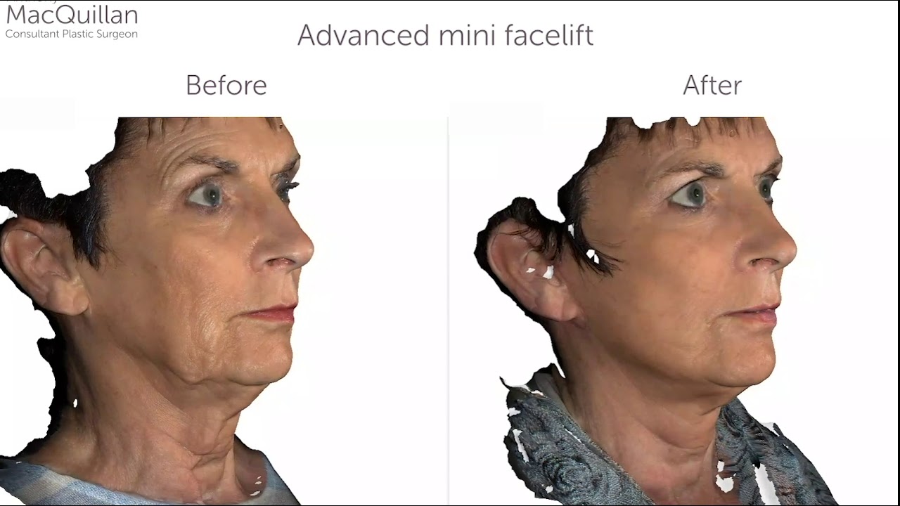 Facelift Before and After