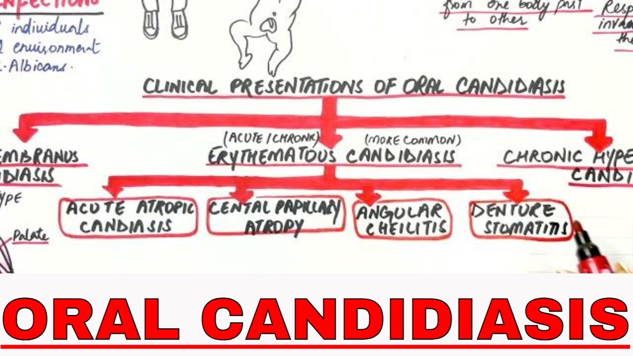 Oral Candidiasis - Causes, Clinical presentations, Treatment