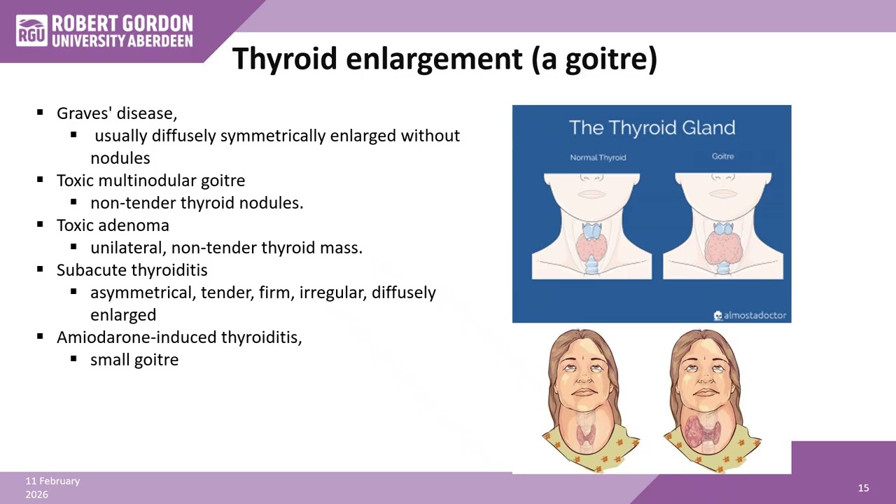 Endocrine3ThyroidHyperThyrd