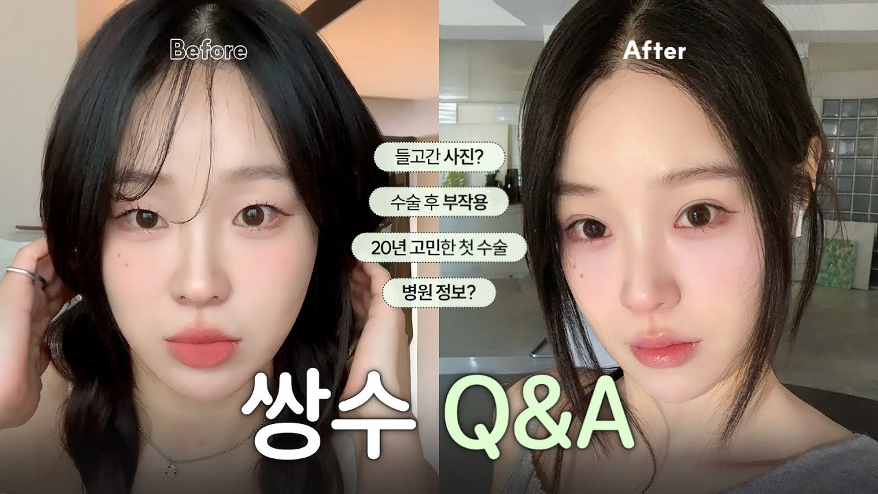 [쌍수Q&A] 쌍수 1개월차👀 달미들이 궁금해했던거 다 대답해드립니다🤍  