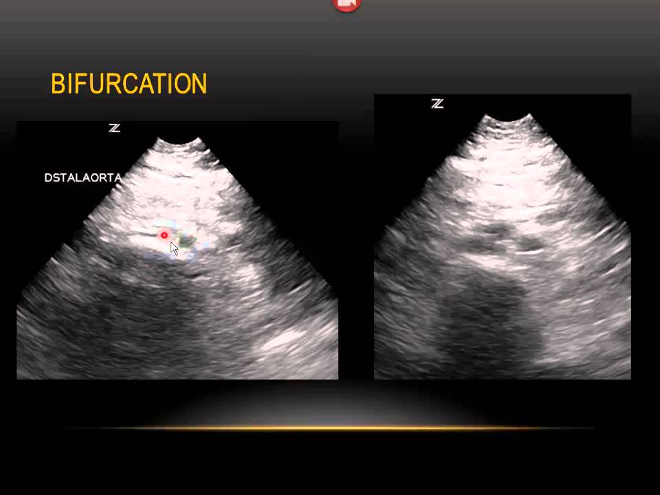 US of the Aorta