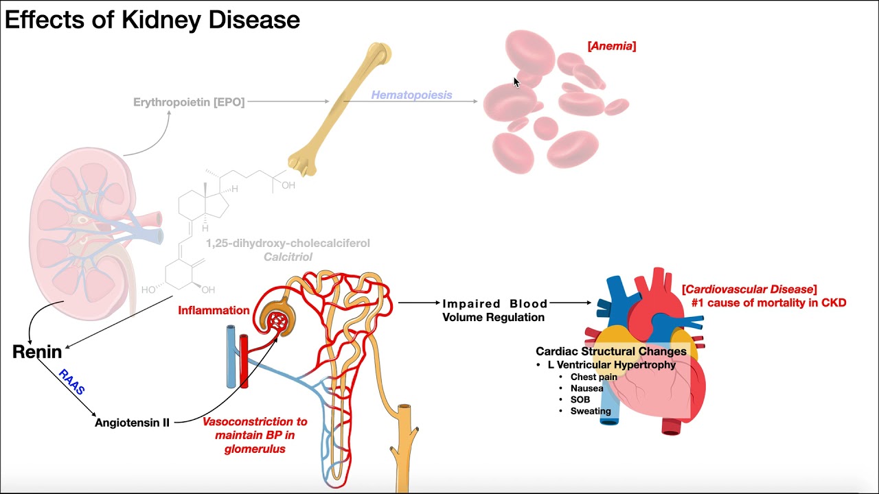 Chronic Kidney Disease EXPLAINED [Pathogenesis, Effects, & Staging]