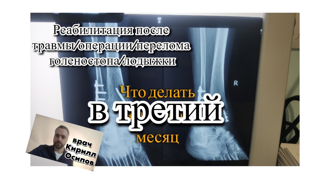 Реабилитация после перелома лодыжки, голени. Третий месяц. Что делать.