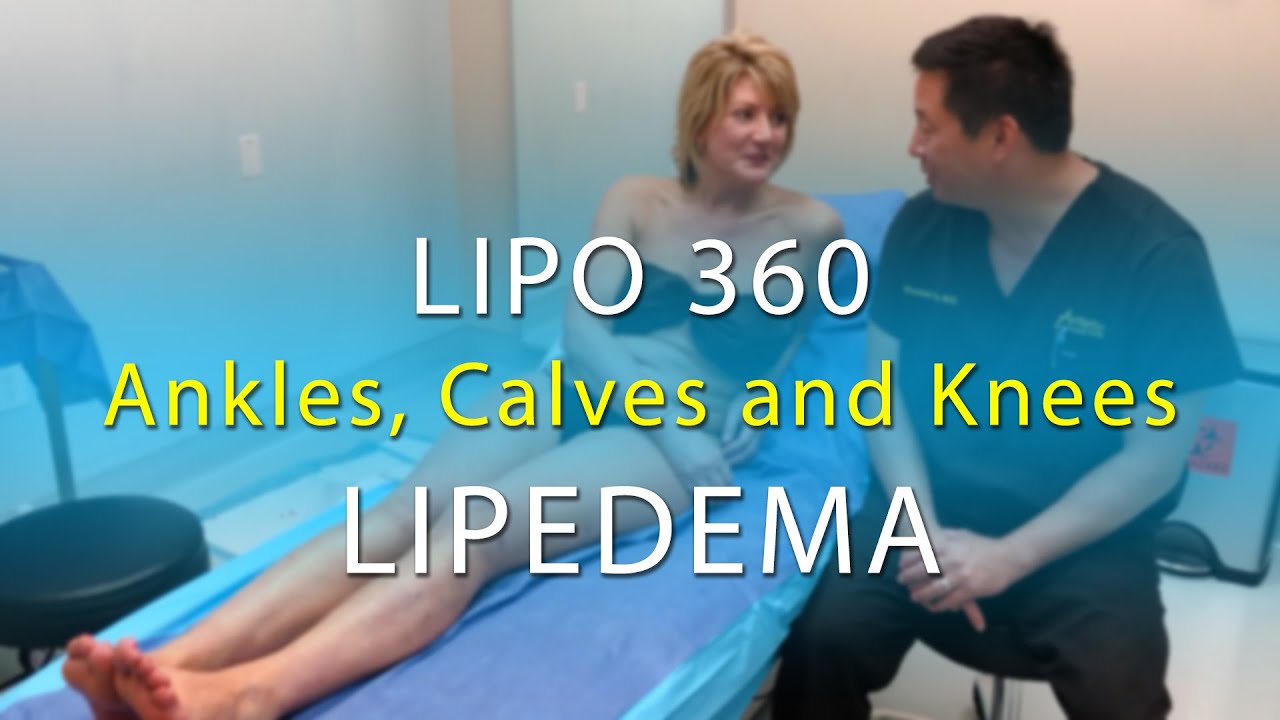 Lipedema Leg Liposuction Surgery Results | Lipo 360° Legs | Cankles & Knees | Expert Dr. Thomas Su