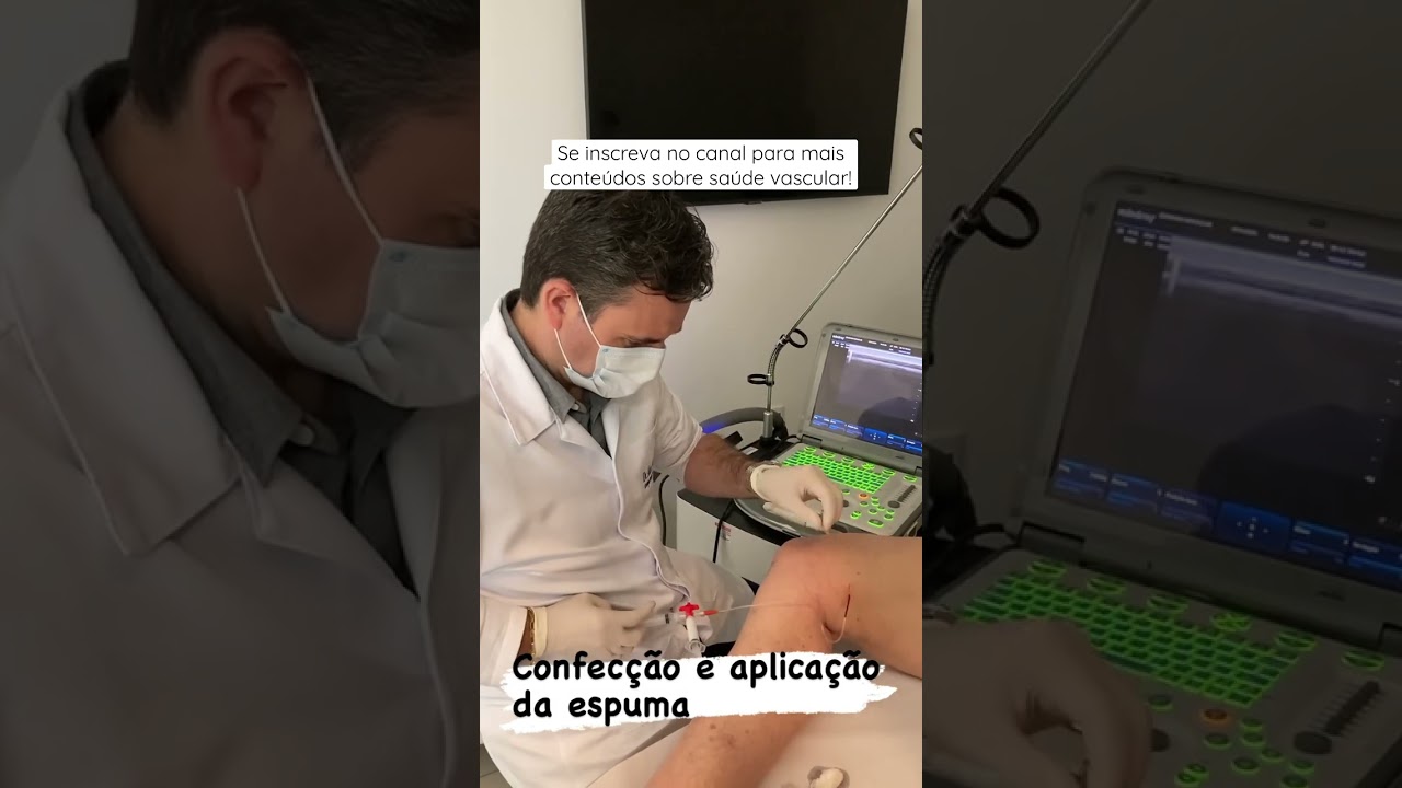 Tratamento da safena com espuma ecoguiada