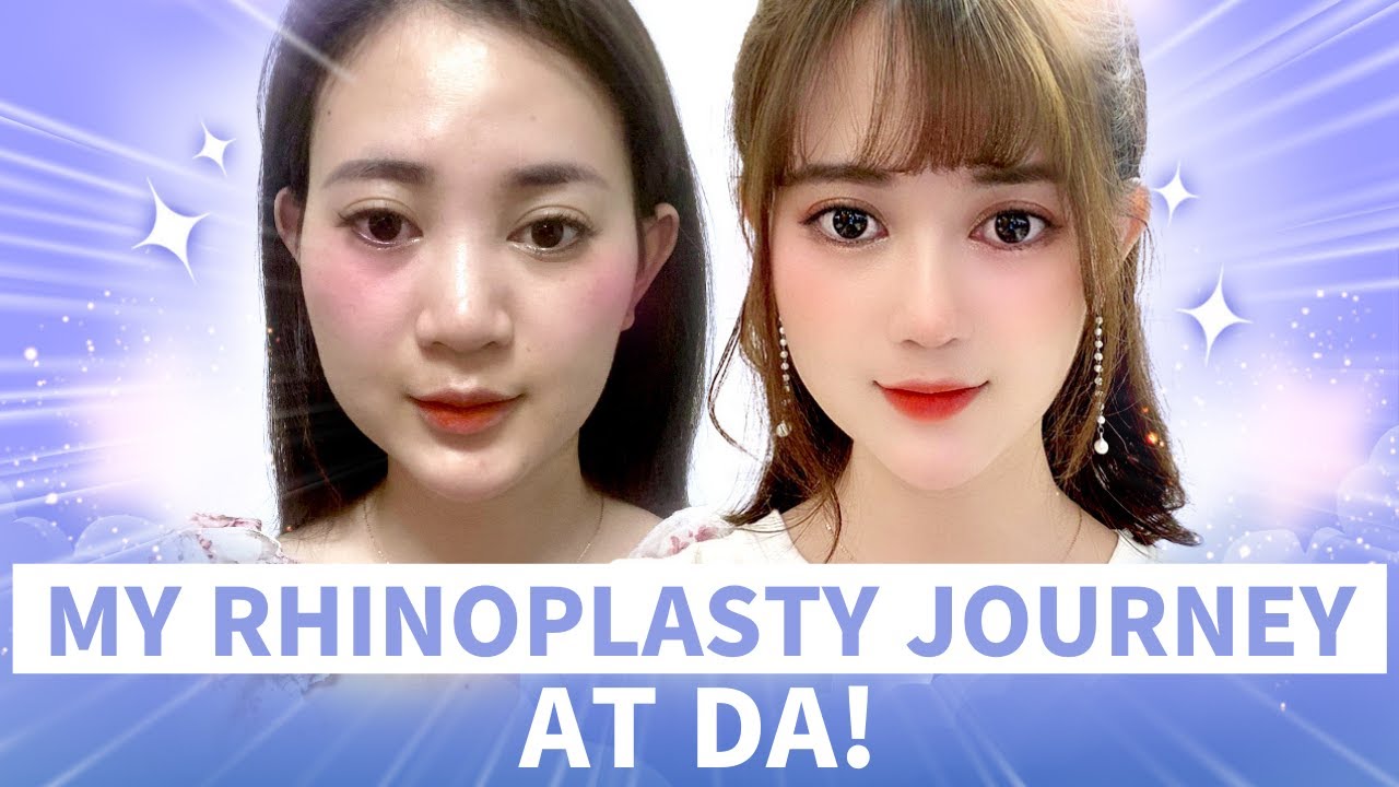 [Korean Rhinoplasty] My Rhinoplasty Journey at DA Plastic Surgery- Before and After