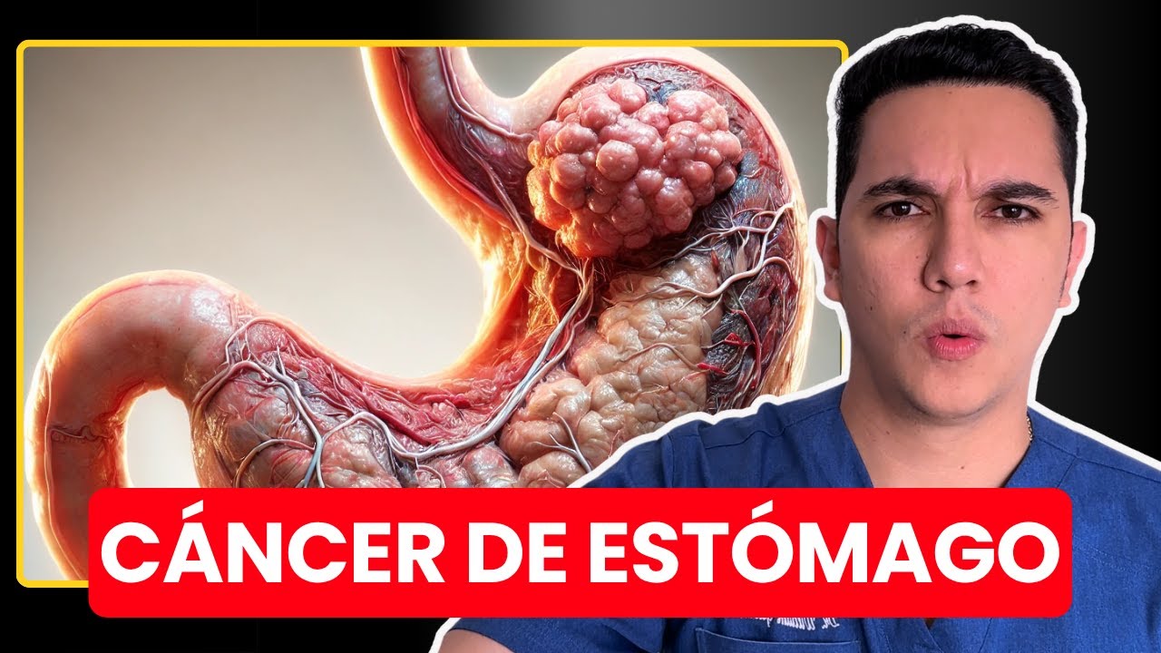 Cáncer de estómago: síntomas, causas y señales tempranas que debes conocer. 