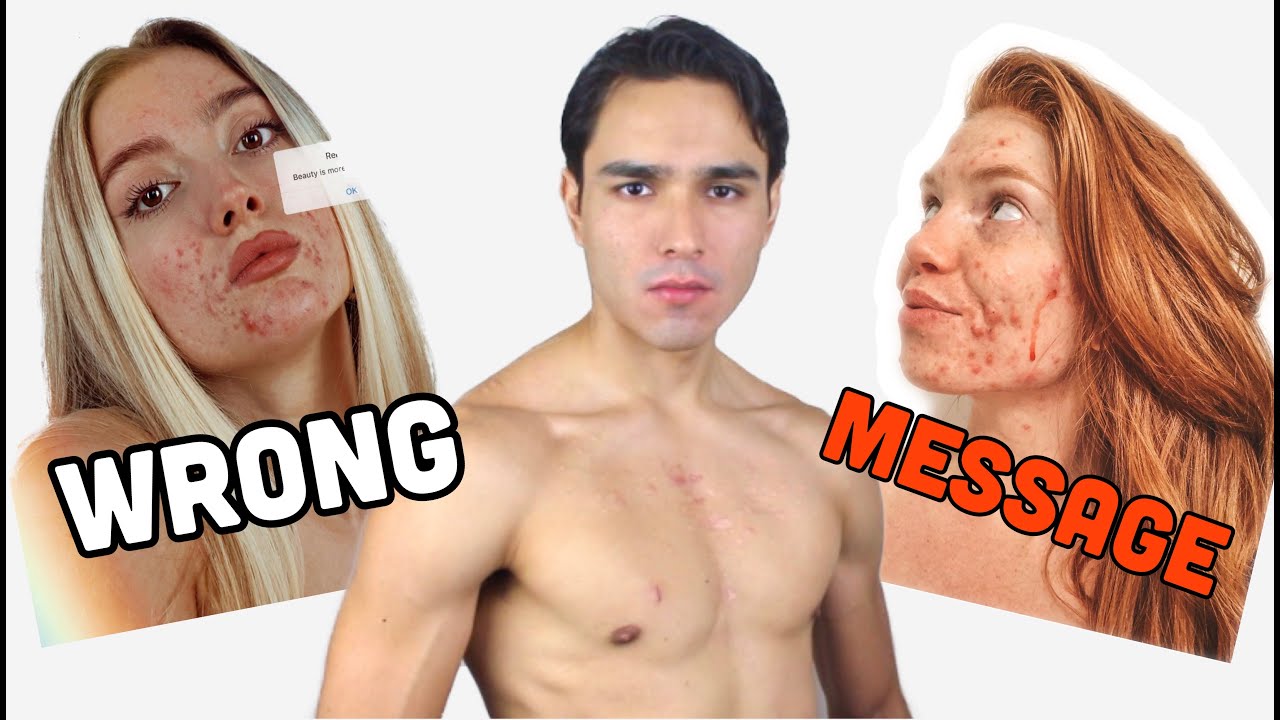The problem with &ldquo;Acne/Skin Positivity&rdquo;