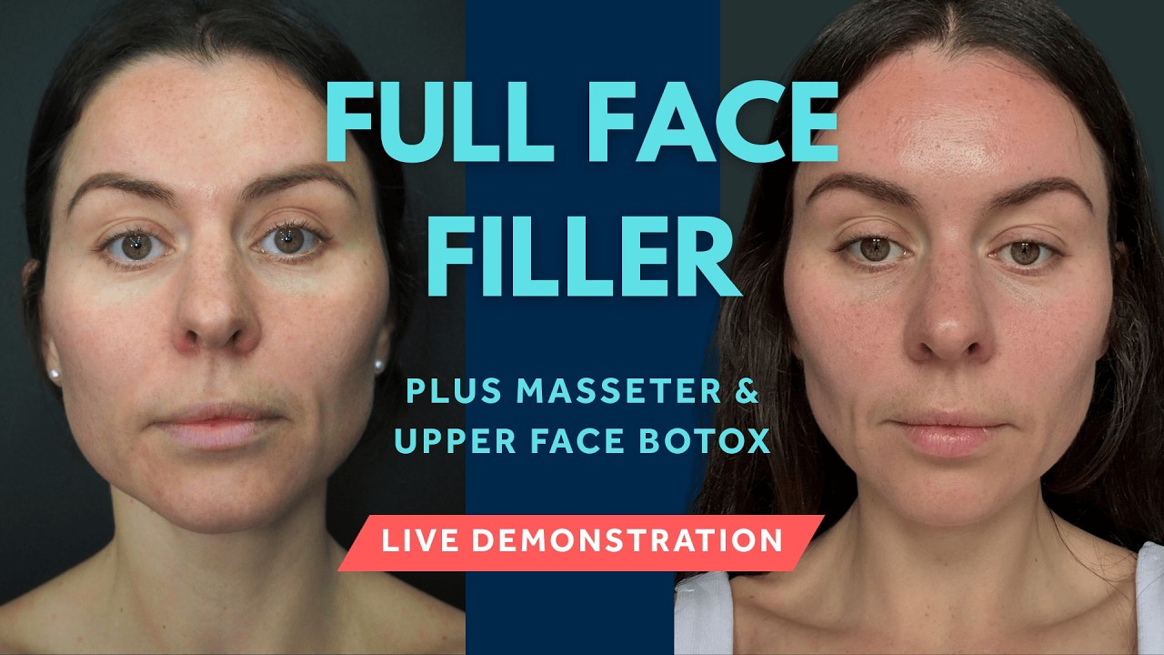Full Length Live Multi-Area Dermal Filler & Toxin Case Study Inc. Masseter Botox & Forehead Filler 💎
