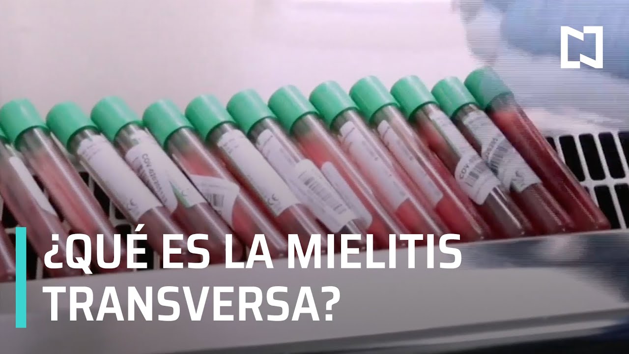 Mielitis Transversa, detectada en voluntario de la vacuna AstraZeneca - Hora 21