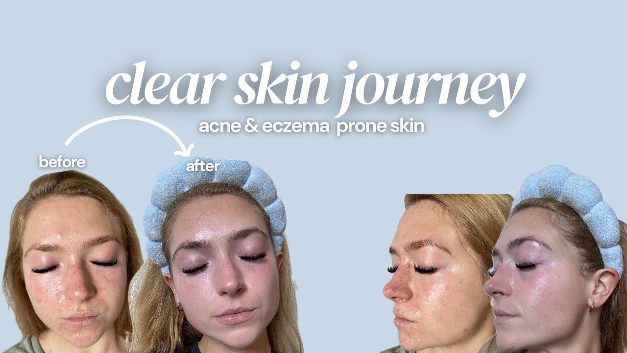 Clear Skin Journey | how i cleared my acne