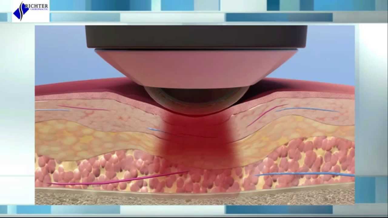 Deep Tissue Laser Therapy: The Science Behind Healing