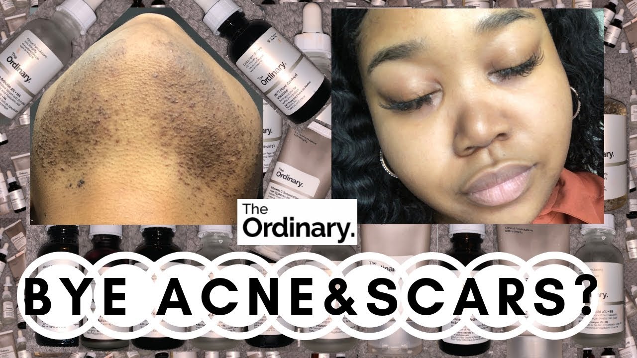 THE ORDINARY • GOODBYE ACNE & HYPERPIGMENTATION?!?