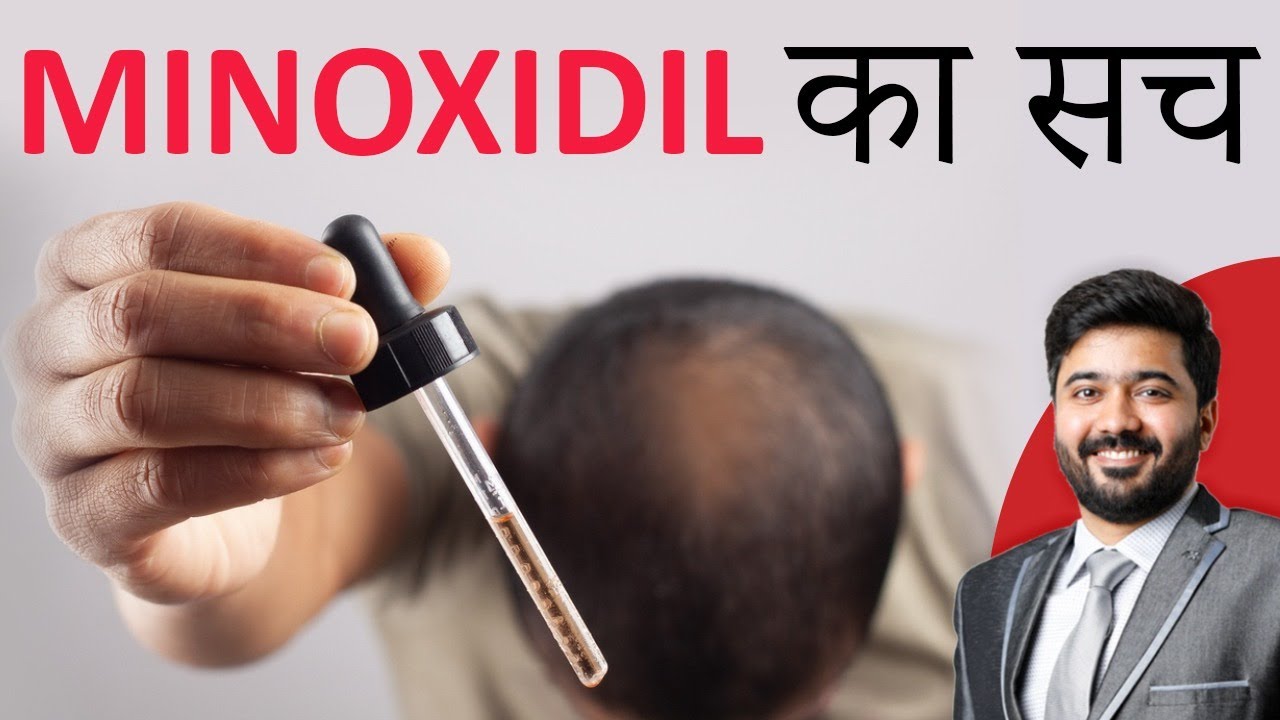 Minoxidil Ka Sach | मिनोक्सिडिल क्या है | By Our Hair Specialist Dr. Shuken Dashore