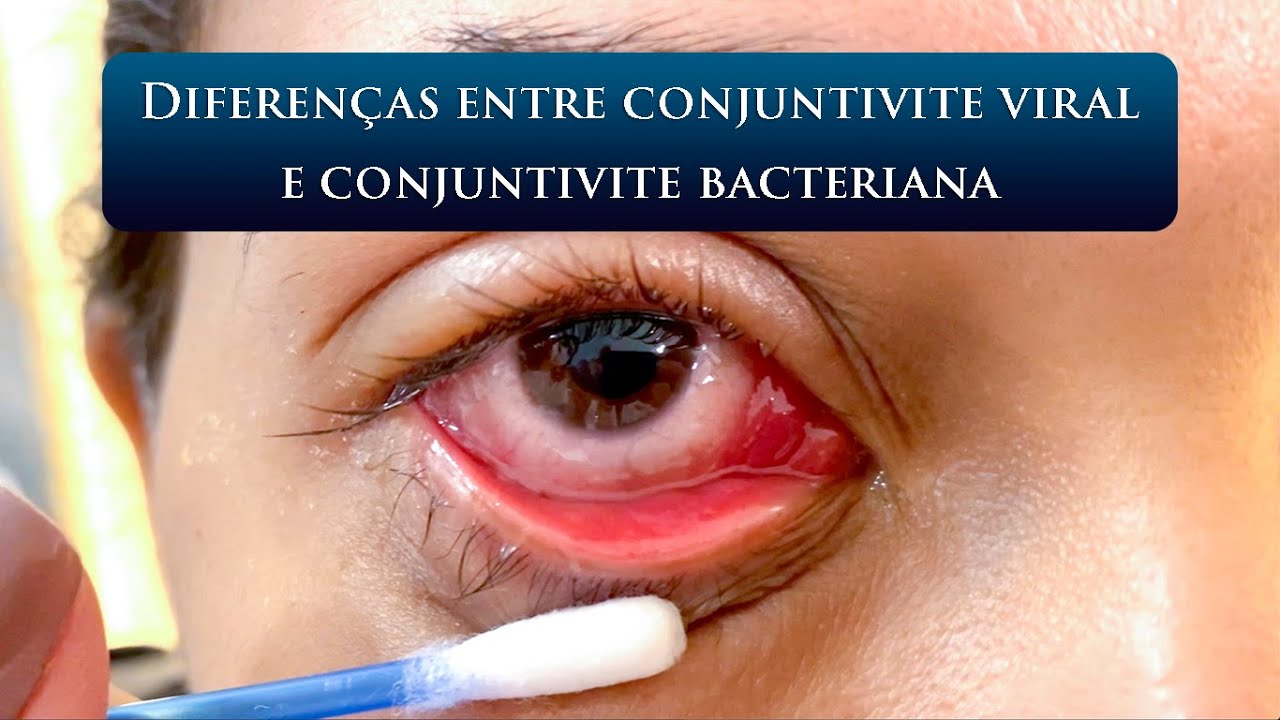 DIFEREN&Ccedil;AS ENTRE CONJUNTIVITE VIRAL E CONJUNTIVITE BACTERIANA