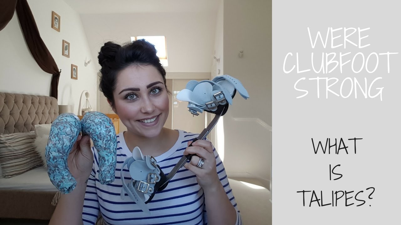 WHAT HAPPENED TO HIS FEET? OUR TALIPES JOURNEY! MUMMA IZZO