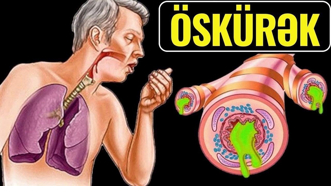 1 Gecəyə Öskürəyi Kəsən Təbii Müalicə