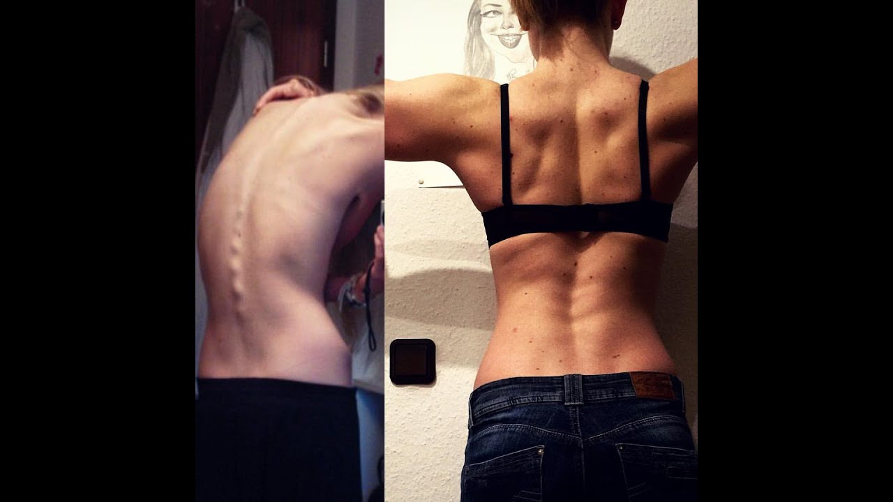 Von der Magersucht Zum Bodybuilding (mit Laura Pape)