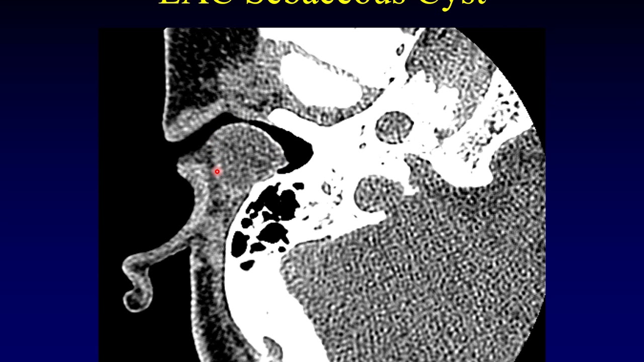 Temporal Bone Pathology 1:  Intro and External Auditory Canal