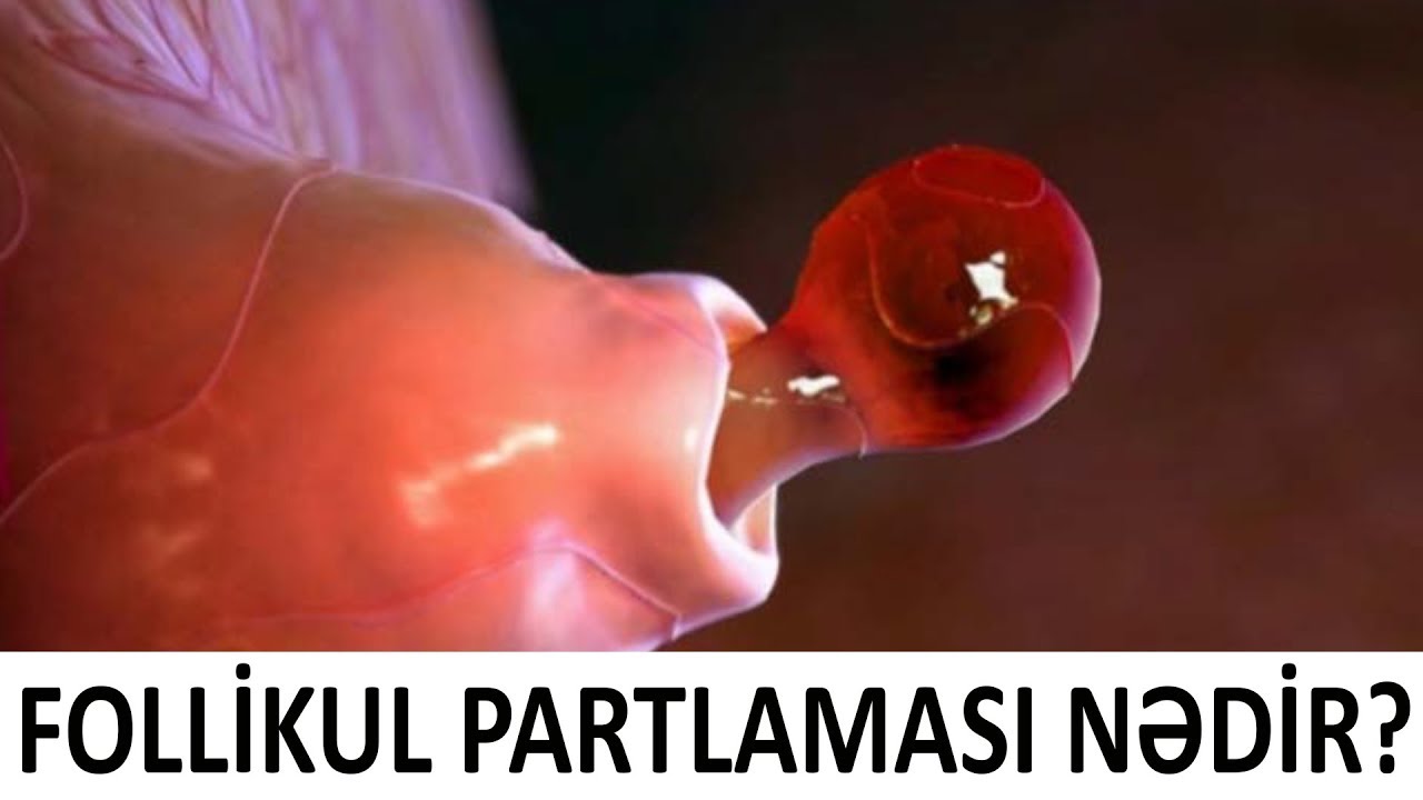Qadınlar diqqət! Follikul nə vaxt partlayır?