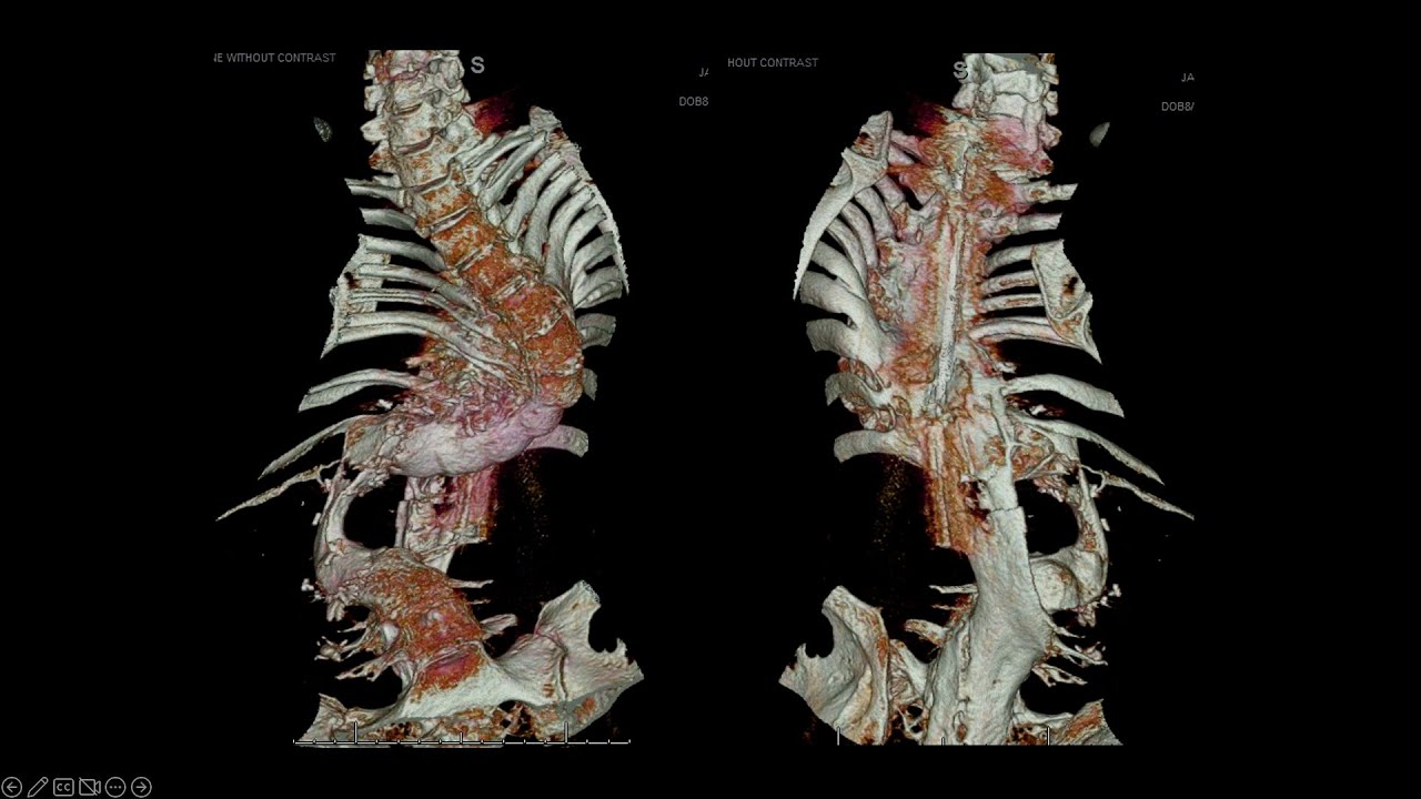 Surgical Navigation Present and Future Use in Complex Spine and Deformity Surgery - Shane Burch, MD